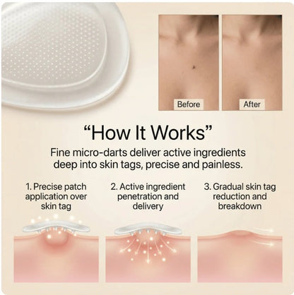 DermaSmooth™ - Tag & Mole Remover Patches ❤️🩹 | Buy 1 Get 1 Free ✨
